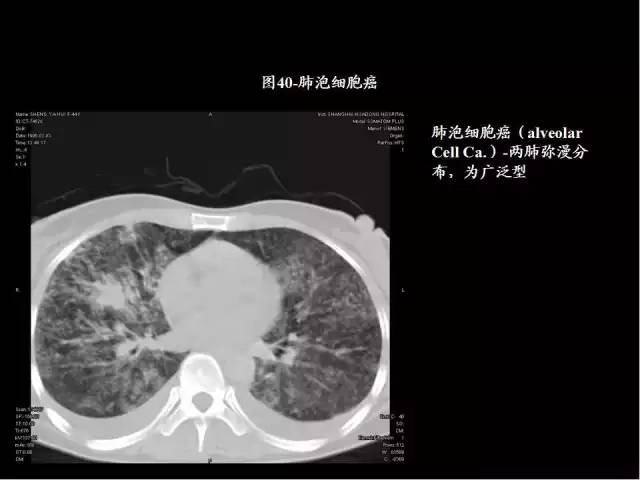 為什么做胸、腹部CT掃描時(shí)需要吸氣-屏氣-吐氣？